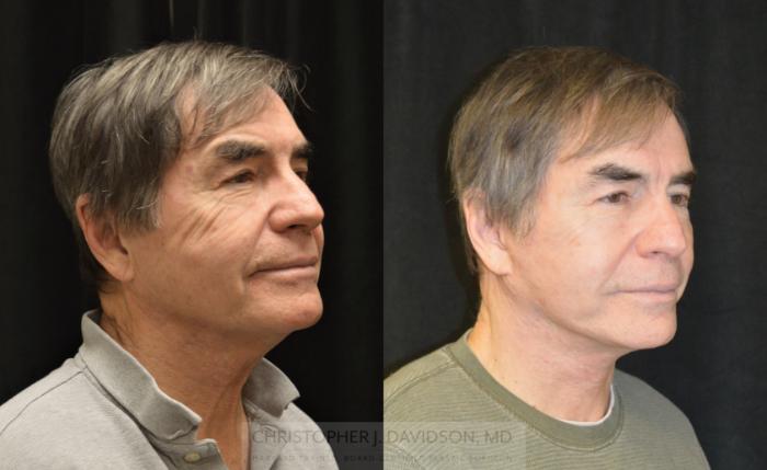 Facelift Surgery Case 330 Before & After Right Oblique | Boston, MA | Christopher J. Davidson, MD