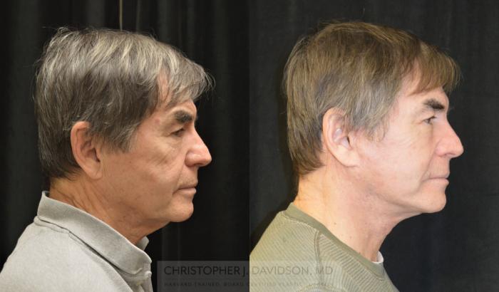 Facelift Surgery Case 330 Before & After Right Side | Boston, MA | Christopher J. Davidson, MD