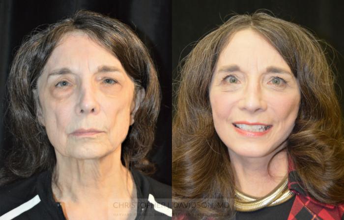 Facelift Surgery Case 331 Before & After Front | Boston, MA | Christopher J. Davidson, MD