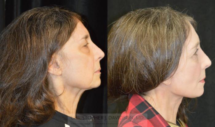 Neck Lift Case 331 Before & After Right Side | Boston, MA | Christopher J. Davidson, MD