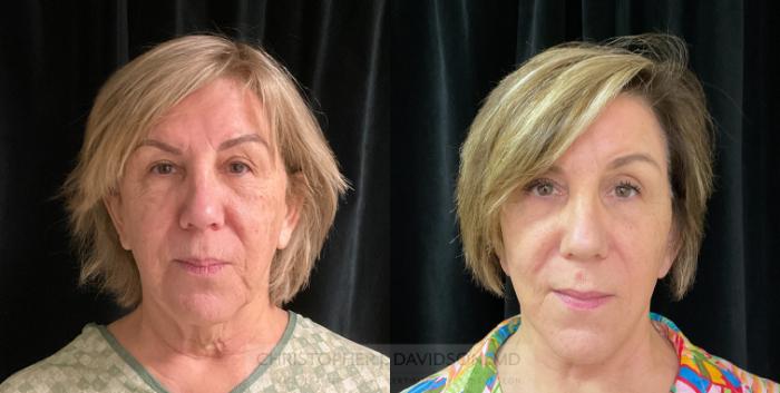 Facelift Surgery Case 333 Before & After Front | Boston, MA | Christopher J. Davidson, MD