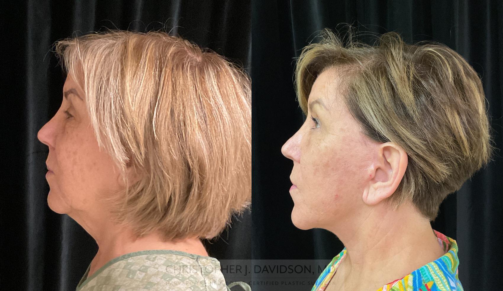 Facelift Surgery Before And After Pictures Case 333 Boston Ma Christopher J Davidson Md 5778