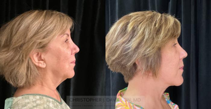 Facelift Surgery Case 333 Before & After Right Side | Boston, MA | Christopher J. Davidson, MD