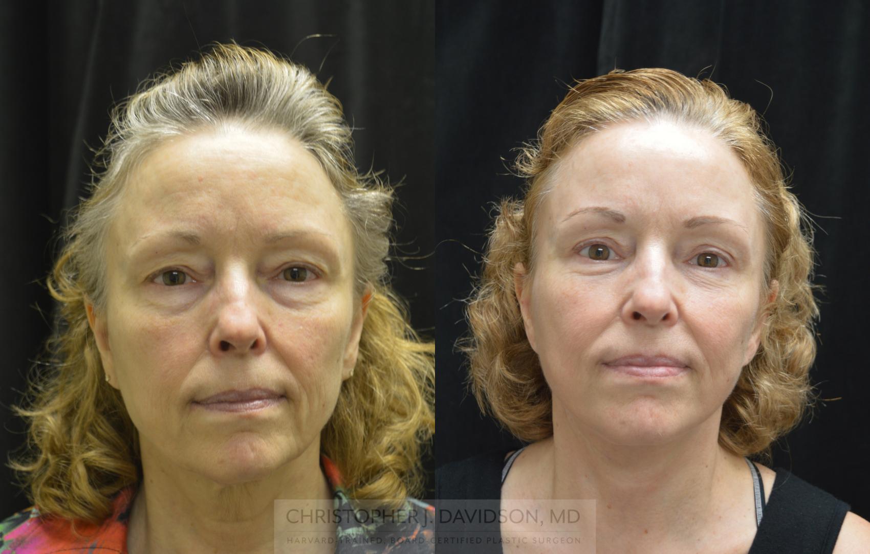 Neck Lift Case 340 Before & After Front | Boston, MA | Christopher J. Davidson, MD