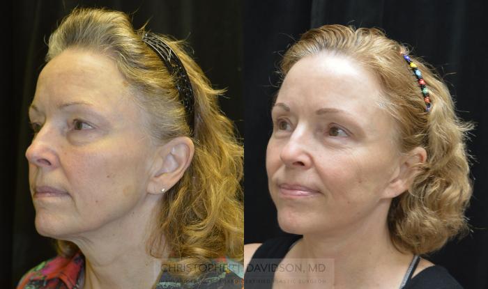 Facelift Surgery Case 340 Before & After Left Oblique | Boston, MA | Christopher J. Davidson, MD