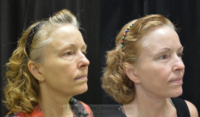 Facelift Surgery Case 340 Before & After Right Oblique | Boston, MA | Christopher J. Davidson, MD