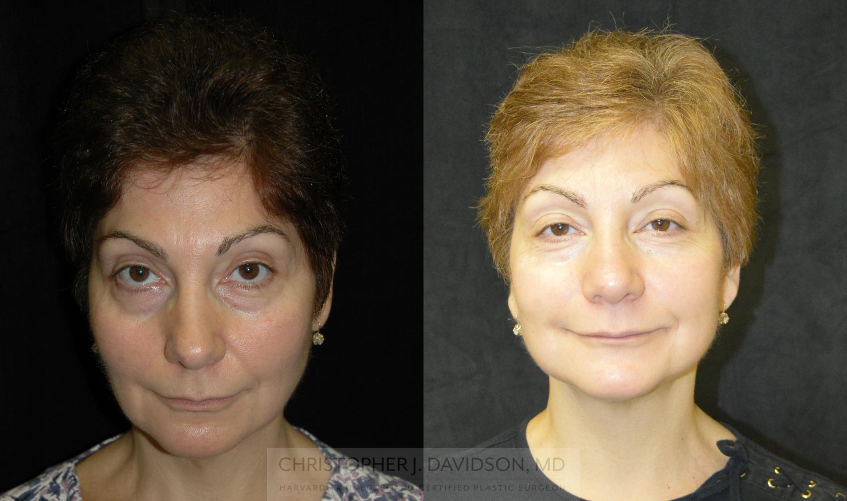 Neck Lift Case 341 Before & After Front | Boston, MA | Christopher J. Davidson, MD