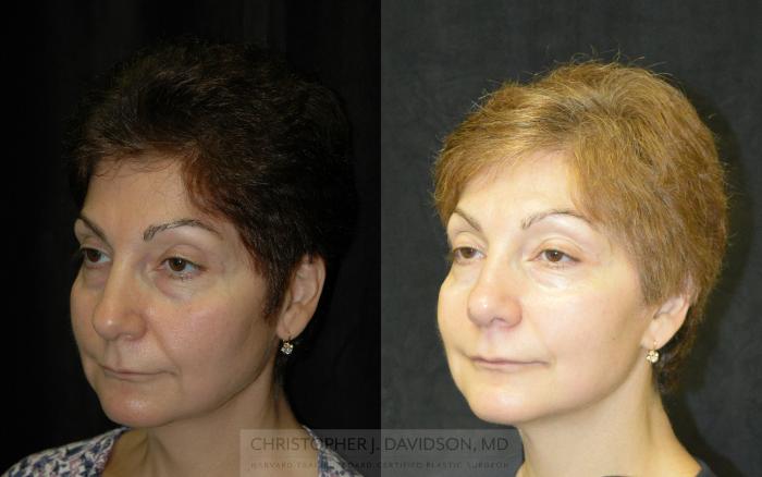Facelift Surgery Case 341 Before & After Left Oblique | Boston, MA | Christopher J. Davidson, MD