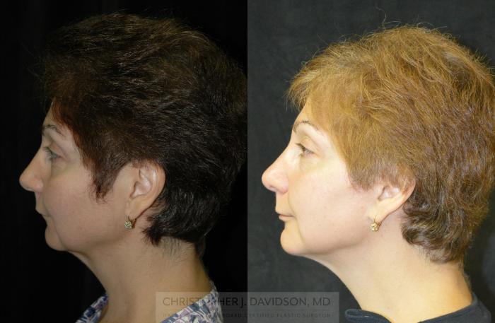 Facelift Surgery Case 341 Before & After Left Side | Boston, MA | Christopher J. Davidson, MD