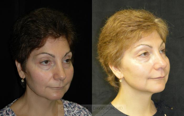 Facelift Surgery Case 341 Before & After Right Oblique | Boston, MA | Christopher J. Davidson, MD