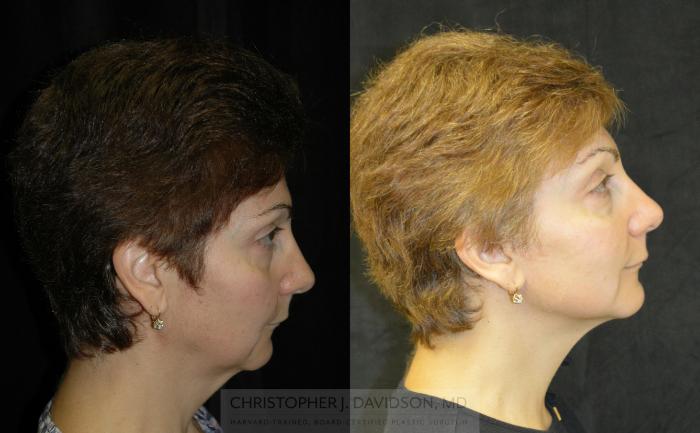 Neck Lift Case 341 Before & After Right Side | Boston, MA | Christopher J. Davidson, MD