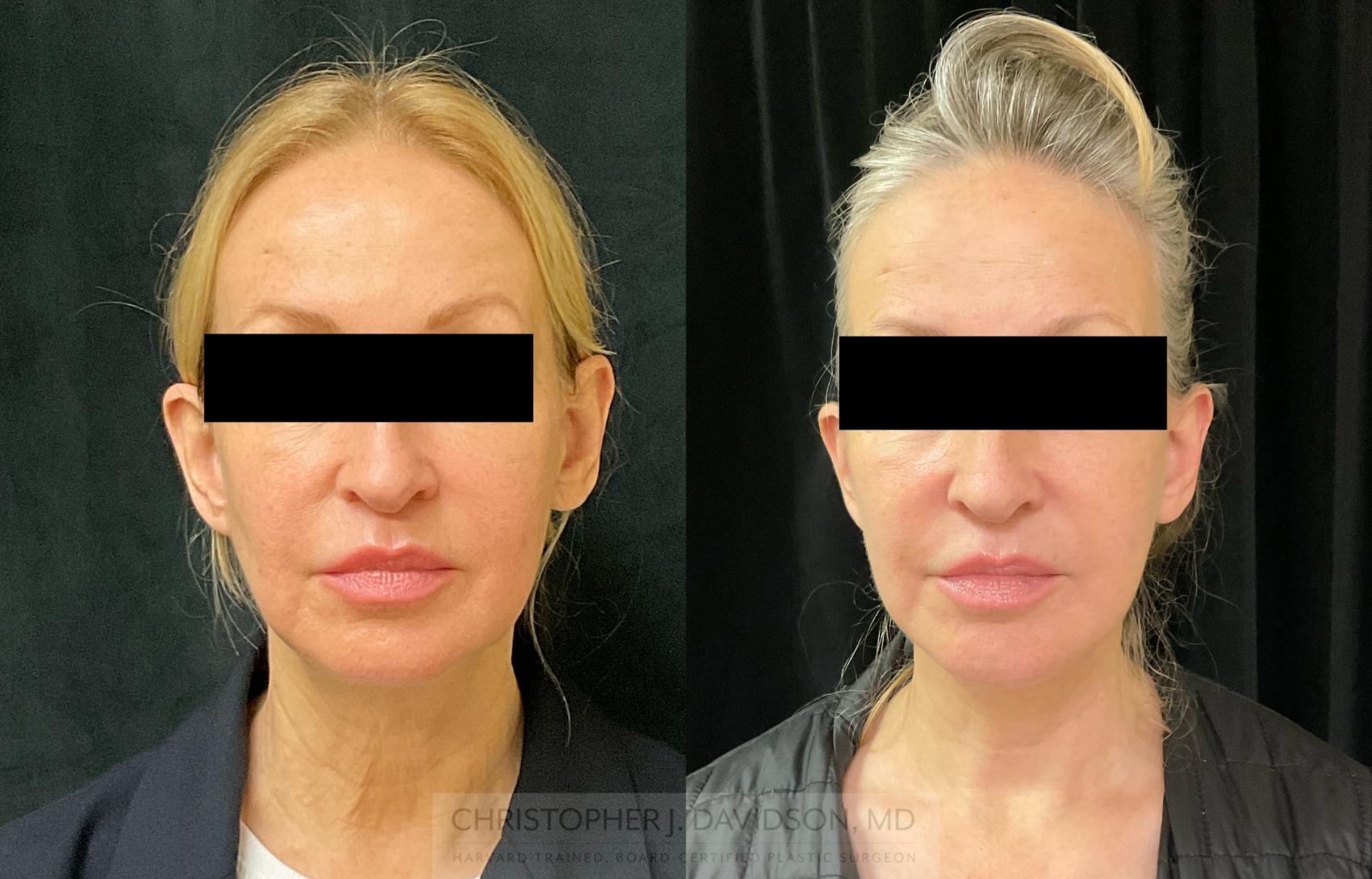 Neck Lift Case 343 Before & After Front | Boston, MA | Christopher J. Davidson, MD