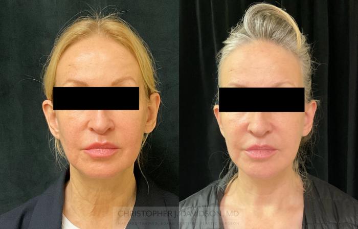 Facelift Surgery Case 343 Before & After Front | Boston, MA | Christopher J. Davidson, MD