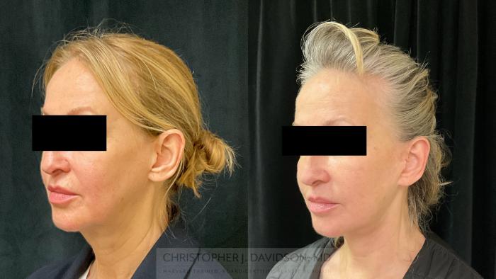 Facelift Surgery Case 343 Before & After Left Oblique | Boston, MA | Christopher J. Davidson, MD