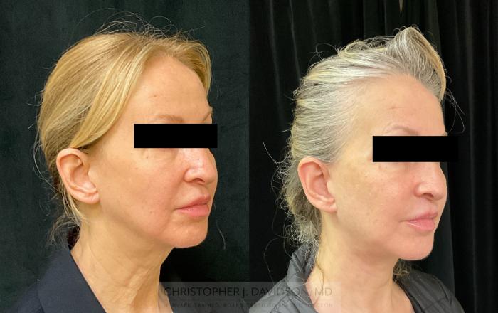 Facelift Surgery Case 343 Before & After Right Oblique | Boston, MA | Christopher J. Davidson, MD