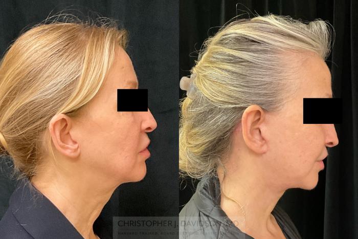 Facelift Surgery Case 343 Before & After Right Side | Boston, MA | Christopher J. Davidson, MD
