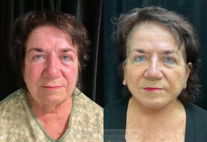 Facelift Surgery Case 349 Before & After Front | Boston, MA | Christopher J. Davidson, MD