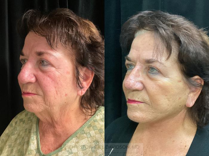 Facelift Surgery Case 349 Before & After Left Oblique | Boston, MA | Christopher J. Davidson, MD