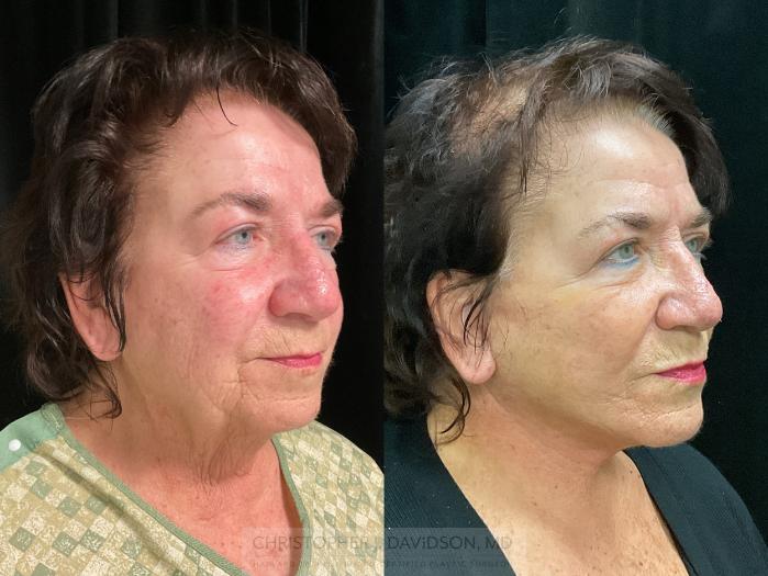 Facelift Surgery Case 349 Before & After Right Oblique | Boston, MA | Christopher J. Davidson, MD