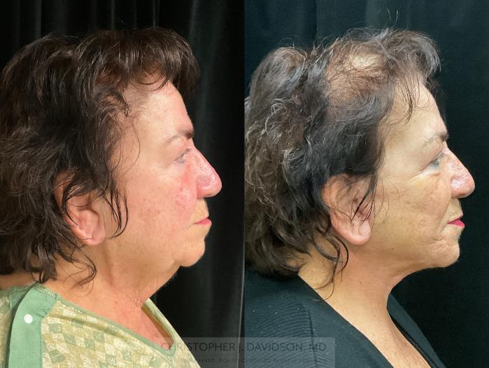 Facelift Surgery Case 349 Before & After Right Side | Boston, MA | Christopher J. Davidson, MD