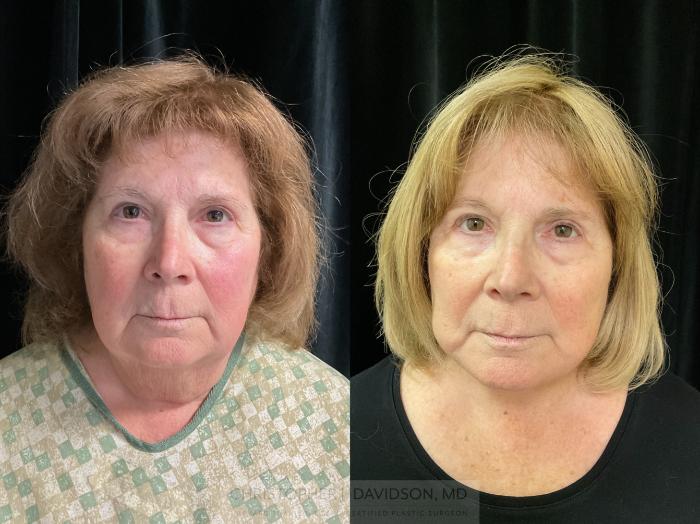 Facelift Surgery Case 362 Before & After Front | Boston, MA | Christopher J. Davidson, MD