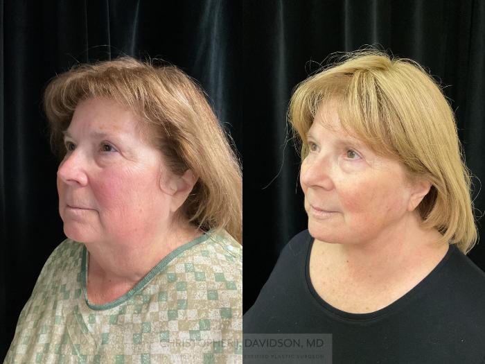 Facelift Surgery Case 362 Before & After Left Oblique | Boston, MA | Christopher J. Davidson, MD