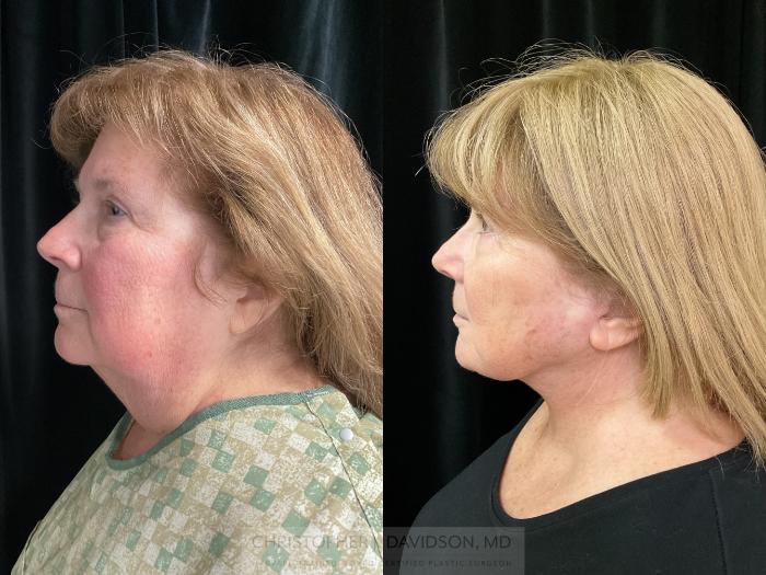 Facelift Surgery Case 362 Before & After Left Side | Boston, MA | Christopher J. Davidson, MD