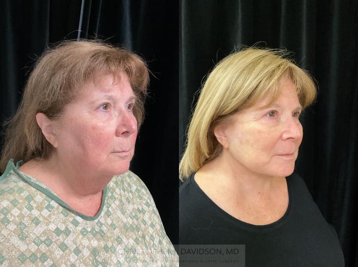 Facelift Surgery Case 362 Before & After Right Oblique | Boston, MA | Christopher J. Davidson, MD