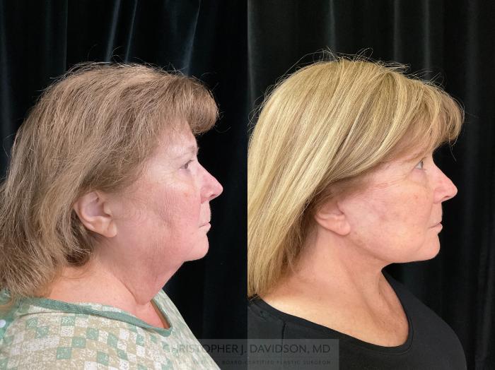 Facelift Surgery Case 362 Before & After Right Side | Boston, MA | Christopher J. Davidson, MD