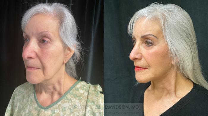 Facelift Surgery Case 365 Before & After Left Oblique | Boston, MA | Christopher J. Davidson, MD