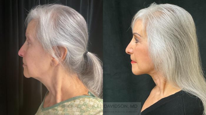 Facelift Surgery Case 365 Before & After Left Side | Boston, MA | Christopher J. Davidson, MD