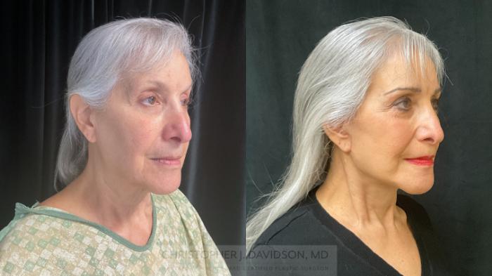 Facelift Surgery Case 365 Before & After Right Oblique | Boston, MA | Christopher J. Davidson, MD