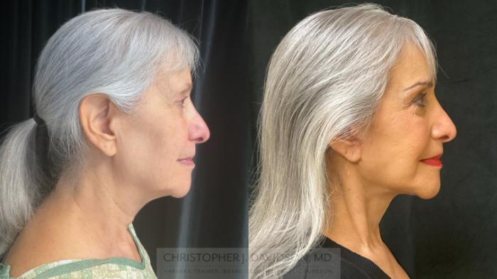 Facelift Surgery Case 365 Before & After Right Side | Boston, MA | Christopher J. Davidson, MD