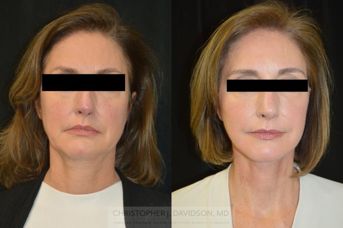 Facelift Surgery Case 382 Before & After Front | Boston, MA | Christopher J. Davidson, MD