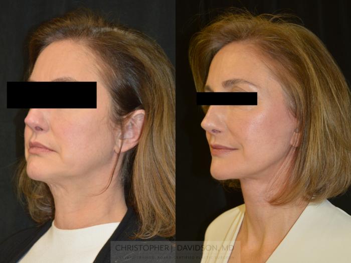 Facelift Surgery Case 382 Before & After Left Oblique | Boston, MA | Christopher J. Davidson, MD