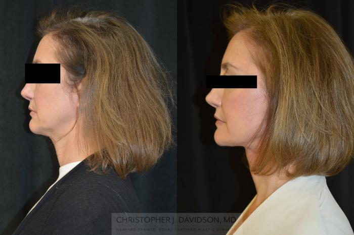 Facelift Surgery Case 382 Before & After Left Side | Boston, MA | Christopher J. Davidson, MD