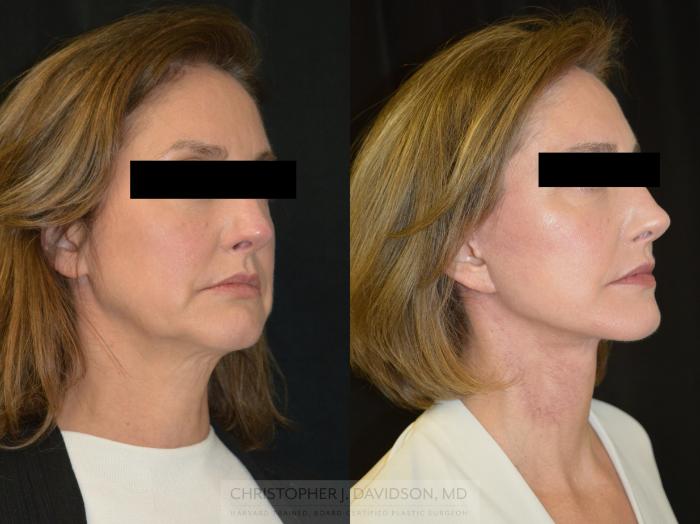 Facelift Surgery Case 382 Before & After Right Oblique | Boston, MA | Christopher J. Davidson, MD