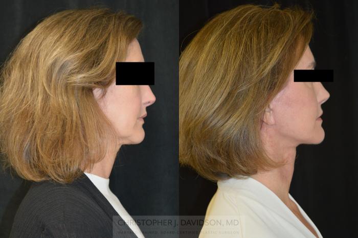 Facelift Surgery Case 382 Before & After Right Side | Boston, MA | Christopher J. Davidson, MD