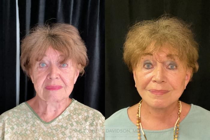 Facelift Surgery Case 384 Before & After Front | Boston, MA | Christopher J. Davidson, MD