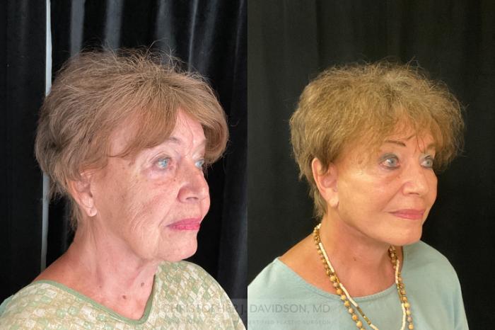 Facelift Surgery Case 384 Before & After Right Oblique | Boston, MA | Christopher J. Davidson, MD