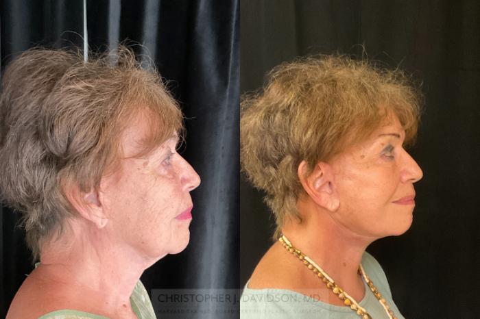 Facelift Surgery Case 384 Before & After Right Side | Boston, MA | Christopher J. Davidson, MD