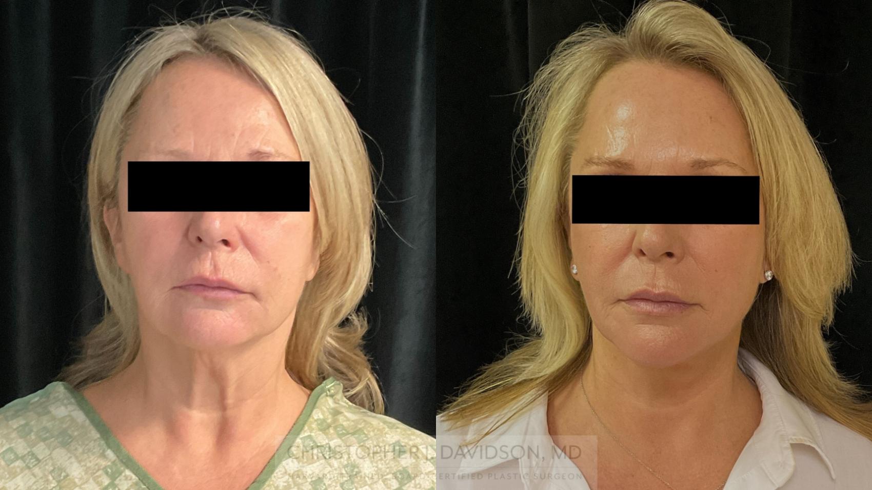 Facelift Surgery Case 386 Before & After Front | Boston, MA | Christopher J. Davidson, MD