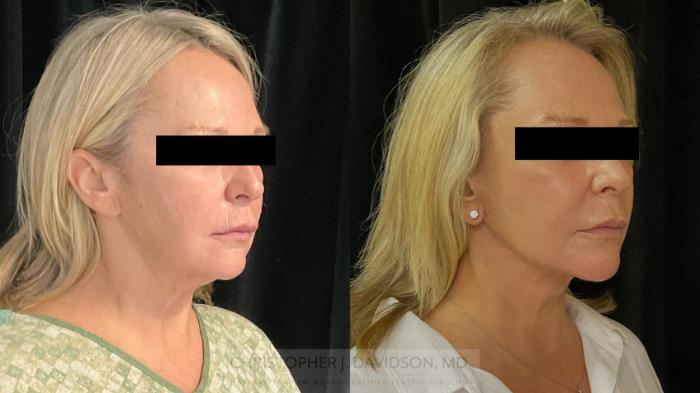 Facelift Surgery Case 386 Before & After Right Oblique | Boston, MA | Christopher J. Davidson, MD