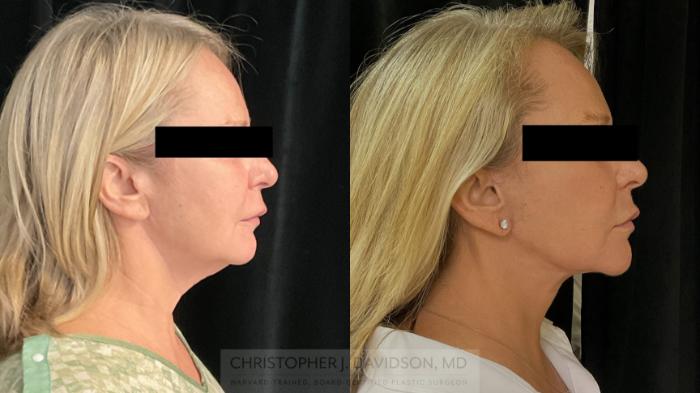 Facelift Surgery Case 386 Before & After Right Side | Boston, MA | Christopher J. Davidson, MD