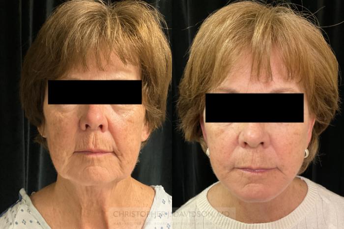 Neck Lift Case 387 Before & After Front | Boston, MA | Christopher J. Davidson, MD