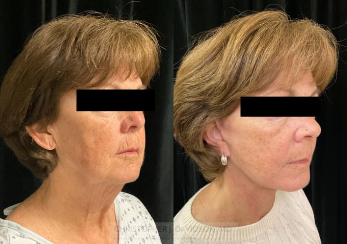 Neck Lift Case 387 Before & After Right Oblique | Boston, MA | Christopher J. Davidson, MD