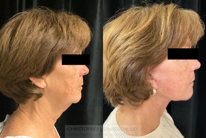 Neck Lift Case 387 Before & After Right Side | Boston, MA | Christopher J. Davidson, MD