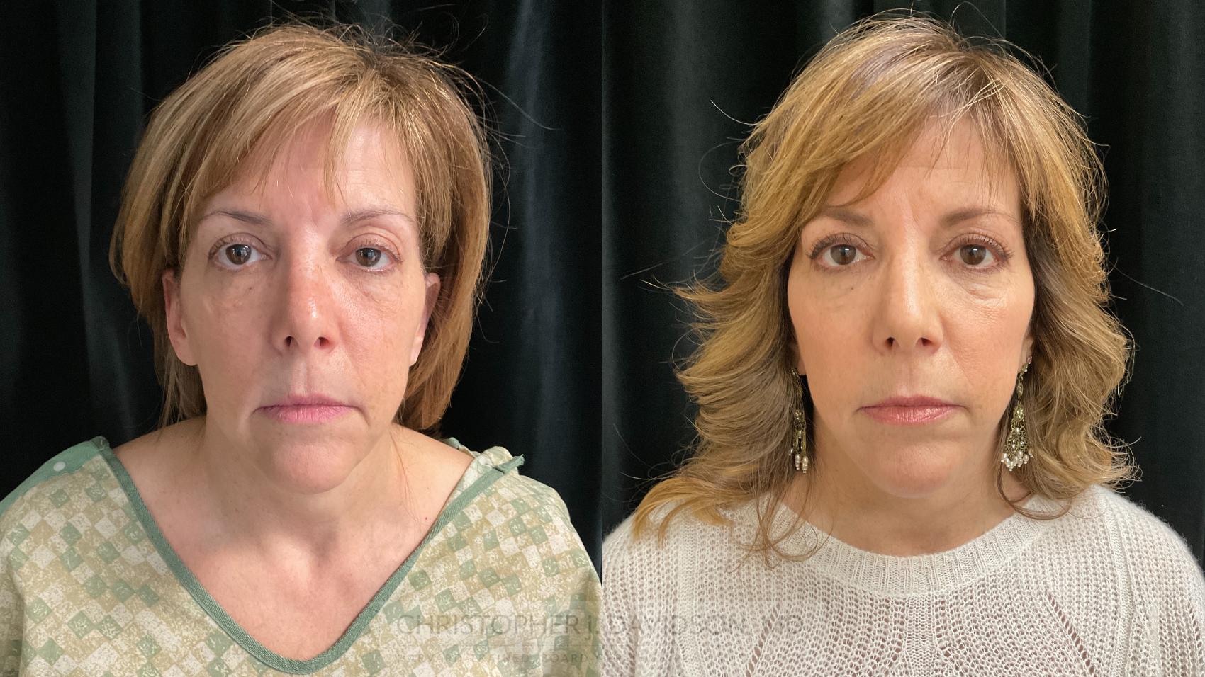 Facelift Surgery Case 395 Before & After Front | Boston, MA | Christopher J. Davidson, MD