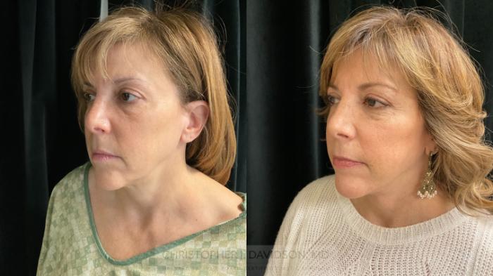 Facelift Surgery Case 395 Before & After Left Oblique | Boston, MA | Christopher J. Davidson, MD