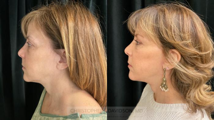 Facelift Surgery Case 395 Before & After Left Side | Boston, MA | Christopher J. Davidson, MD